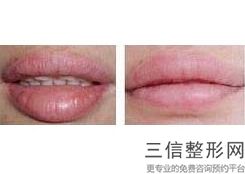 激光脱毛的价格多少，激光唇部脱毛多少钱