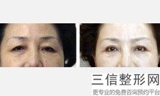 几月份割双眼皮比较适合，割双眼皮几月份做比较好