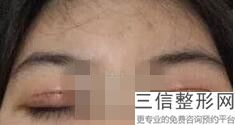 几月份割双眼皮比较适合，割双眼皮几月份做比较好