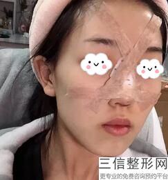 假体隆鼻后多长时间才能恢复，假体隆鼻多久彻底恢复好