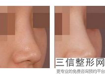 假体隆鼻能保持几年,假体硅胶隆鼻能管多少年