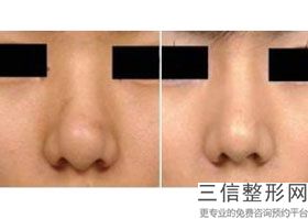 假体隆鼻能保持几年,假体硅胶隆鼻能管多少年