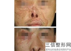假体隆鼻怎么消肿，做完假体鼻子怎么消肿快