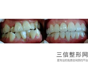 矫正牙齿很痛怎么缓解，矫正牙齿时牙疼怎么缓解