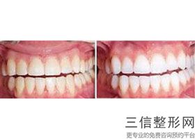 酵素可以美白牙齿吗，白牙素可以美白牙齿吗