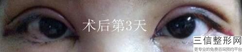 开眼角比较好的医院，开内眼角哪家医院好