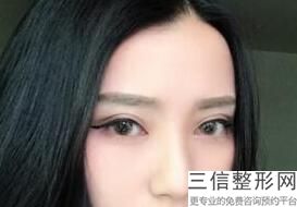 开眼角的副作用大吗，开眼角有啥用