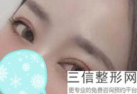 开眼角的副作用大吗，开眼角有啥用