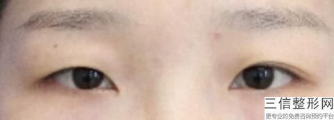 开眼角的副作用大吗，开眼角有啥用