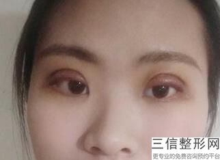 开眼角手术过程要睁眼吗，什么叫开眼角手术