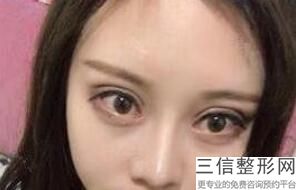 开眼角手术视频，开内眼角手术怎么做