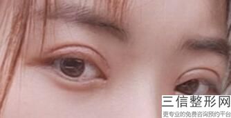 开眼角手术有什么效果，为什么要开眼角手术