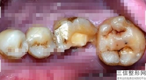烤瓷牙多少钱一颗价格表2，一般烤瓷牙多少钱一颗,全瓷烤瓷牙多少钱一颗