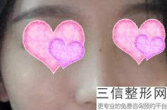 隆鼻失败还能恢复成原来么,隆鼻是不是要一直修复