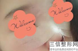 隆鼻手术失败要多久可以重新修复，隆鼻失败多久能做修复