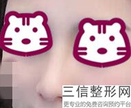 隆鼻子需要多久恢复自然，隆鼻术后多久可以完全恢复