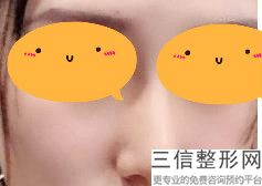 隆鼻做成了朝天鼻，隆鼻隆成朝天鼻
