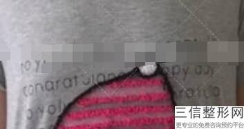 隆胸后多久能穿内衣，隆胸术后内衣穿多久