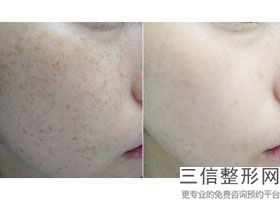 洛阳四院皮肤科光子嫩肤，沈阳光子嫩肤哪家医院好