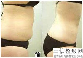 妈妈臀吸脂多久可以恢复，臀部吸脂失败