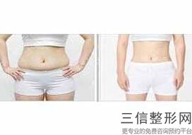 妈妈臀吸脂多久可以恢复，臀部吸脂失败