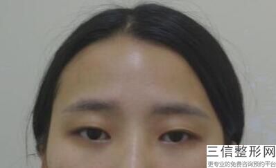 埋线双眼皮失败可以恢复原样吗-,埋线双眼皮失败好修复吗
