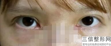 眉弓用脂肪填充好吗，什么样的眉弓需要填充