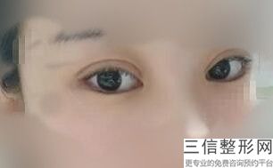 眉弓用脂肪填充好吗，什么样的眉弓需要填充