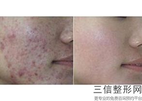 美白针的缺点有哪些，美白针效果好不好