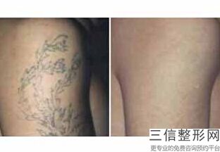 美白针真的能美白吗，美白针的效果明显吗