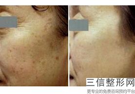 美白针真的能美白吗，美白针的效果明显吗