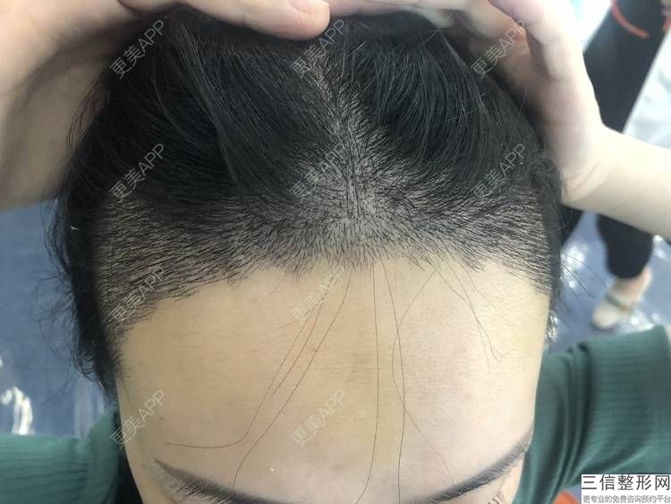 美人尖种植后图片欣赏，有美人尖的男人能嫁吗