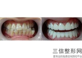 木渎医院拔牙多少钱，苏州哪里拔牙便宜