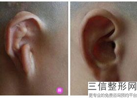 哪里做附耳切除比较好,附耳切除武汉哪家医院好