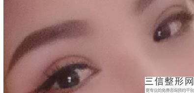 哪种眼睛不适合割双眼皮，哪些人不适合割双眼皮