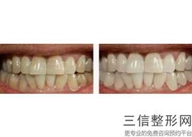 南京哪个医院矫正牙齿好，南京哪家医院做牙齿矫正比较好