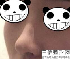 膨体隆鼻后会变形吗，膨体隆鼻危险吗