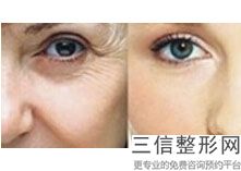 皮肤有点敏感可以打水光针吗，皮肤敏感的时候可以打水光针吗