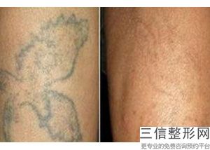 皮肤有点敏感可以打水光针吗，皮肤敏感的时候可以打水光针吗