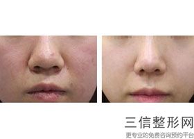 皮秒激光的危害与效果，激光皮秒和蜂巢皮秒的区别
