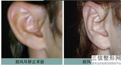 轻度杯状耳矫正多少钱，杯状耳术后效果图