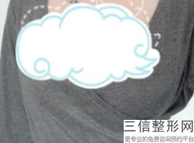 取假体隆胸一般多少钱，做隆胸假体取出大约多少费用