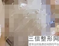 乳房再造术怎么做的呢,什么叫乳房再造术