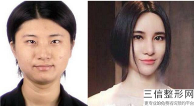 上海公立医院自体脂肪丰胸，上海脂肪丰胸什么医院良好
