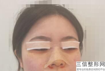 上海哪家整形医院做双眼皮比较好，上海比较好的割双眼皮的医院
