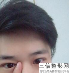 上海哪家整形医院做双眼皮比较好，上海比较好的割双眼皮的医院
