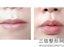 沈阳丰唇哪家好，沈阳哪家纹眉纹的好