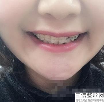 什么样的牙齿算畸形，牙齿畸形的分类