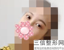 双眼皮手术痕迹多久能消失，做了双眼皮疤痕多久消失