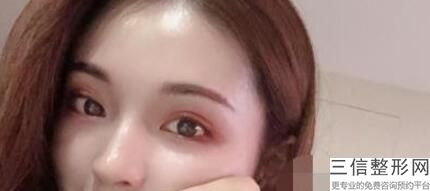 双眼皮手术痕迹多久能消失，做了双眼皮疤痕多久消失